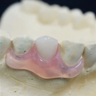 Ön Dişler Nesbit Valplast rahatlıkla çıkarılabilir mi?